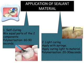 APPLICATION OF SEALANT
MATERIAL
1. Self-Curing
Mix equal parts of the 2
components
Polymerisation: 60-90
seconds. 2. Light curing
Apply with syringe.
Apply curing light to material.
Polymerisation: 20-30seconds.
 