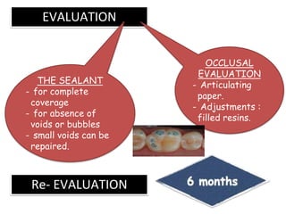 EVALUATION
THE SEALANT
- for complete
coverage
- for absence of
voids or bubbles
- small voids can be
repaired.
OCCLUSAL
EVALUATION
- Articulating
paper.
- Adjustments :
filled resins.
Re- EVALUATION
 