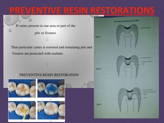 PREVENTIVE RESIN RESTORATIONS
 