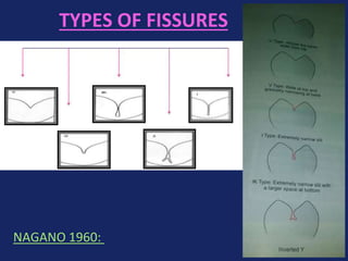 TYPES OF FISSURES
NAGANO 1960:
 