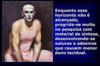 Enquanto esse
horizonte não é
alcançado,
progride-se muito
na pesquisa com
material de síntese,
desenvolvendo-se
suturas e adesivos
que causem menor
dano tecidual.
 