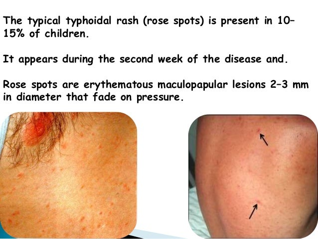 pix Rose Spot Salmonella Rash pit fall in typhoid fever 2016