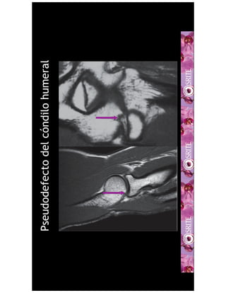 Pseudodefectodelcóndilohumeral
 