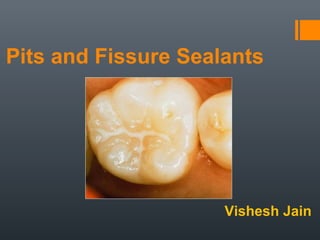 Pits and Fissure Sealants
Vishesh Jain
 