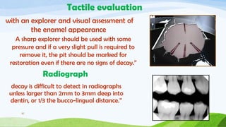 Pit & fissure sealants In children .pptx