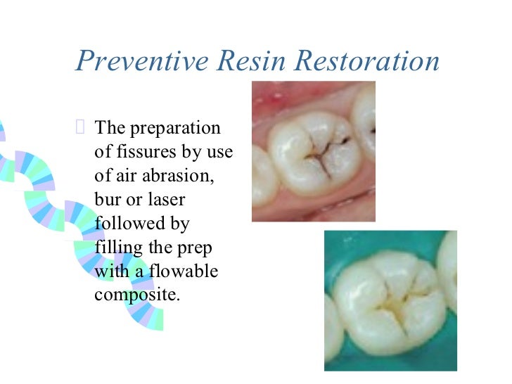 2nd Opinion on *possible* cavity. r/Dentistry