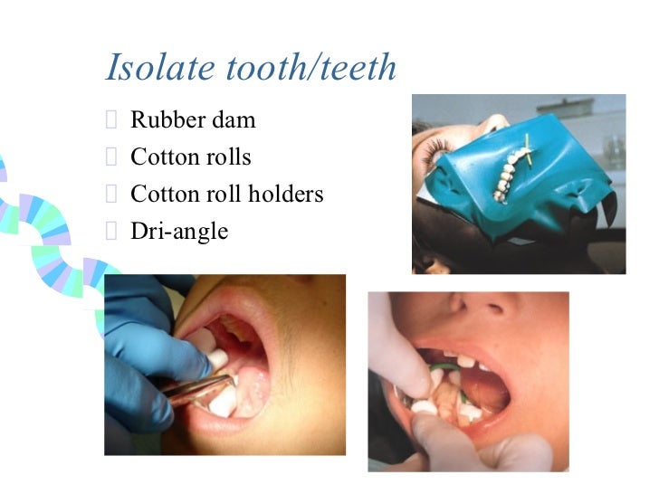 Pit & fissure sealants (1)