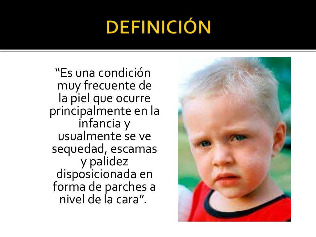 Pitiriasis alba