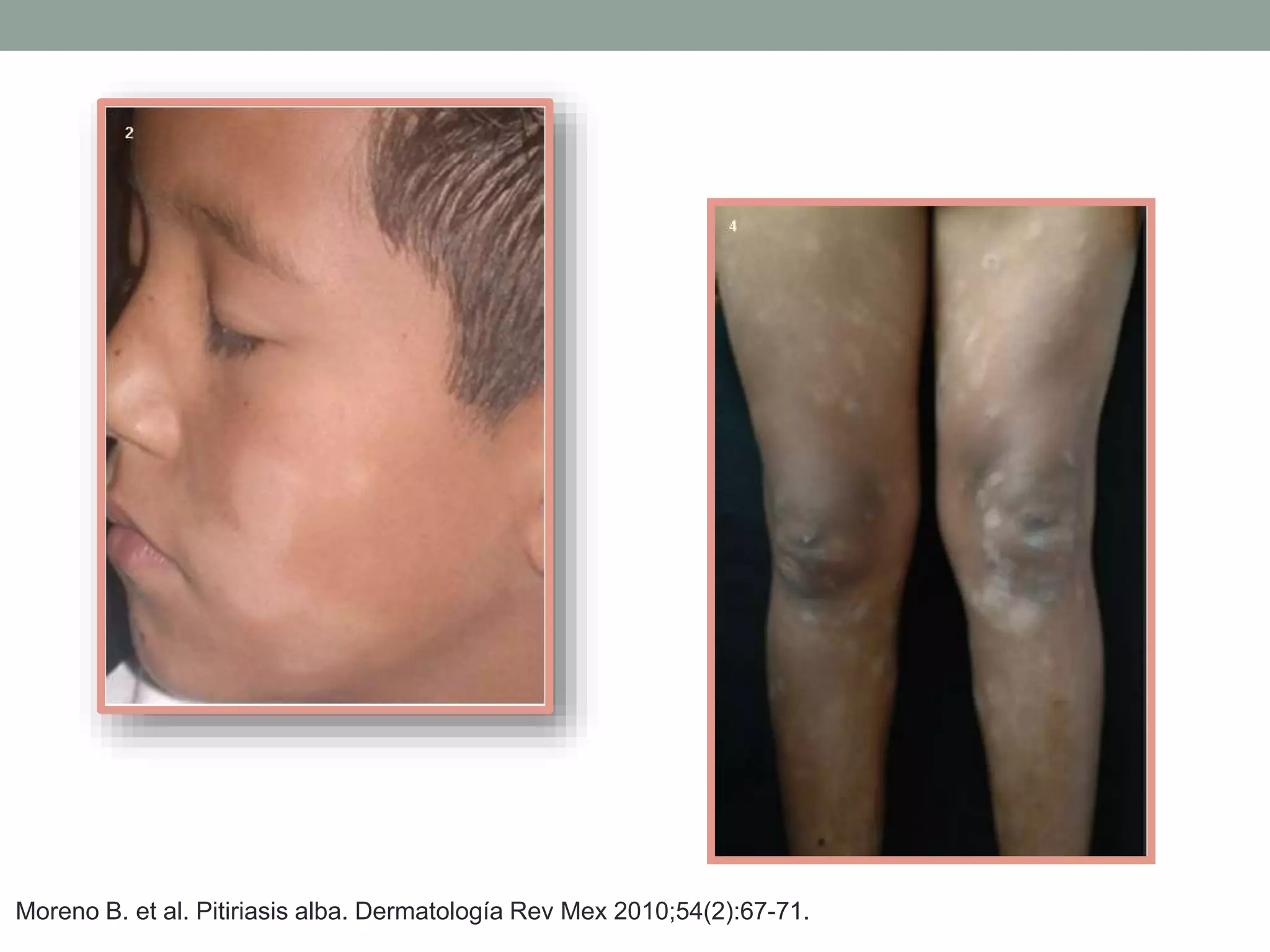 Pitiriasis Alba PPTX Skin And Dermatology Diseases And Conditions