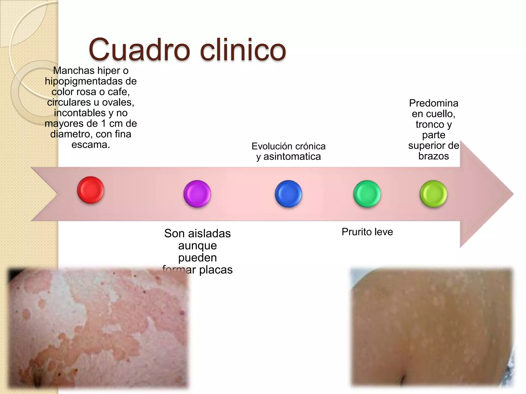 Pitiriasis versicolor | PPTX
