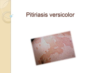 Pitiriasis versicolor
 