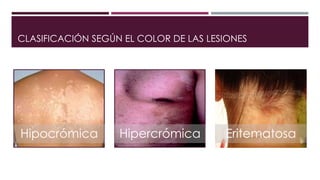CLASIFICACIÓN SEGÚN EL COLOR DE LAS LESIONES 
Hipocrómica Hipercrómica Eritematosa 
 