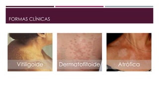 FORMAS CLÍNICAS 
Vitiligoide Dermatofitoide Atrófica 
 