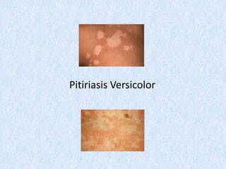 Pitiriasis Versicolor
 