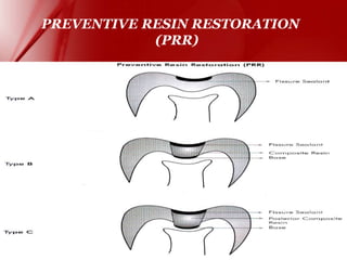 Ppr Rectification pit and fissure sealants used in dentistry | PPT