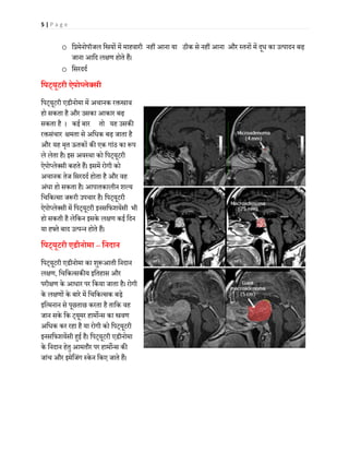 5 | P a g e
o िप्रमेनोपॉजल ि�यों में माहवारी नहीं आना या ठीक से नहीं आना और स्तनों में दूध का उत्पादन बढ़
जाना आिद ल�ण होते हैं।
o िसरददर्
िपट्यूटरी ऐपोप्लेक्सी
िपट्यूटरी एडीनोमा में अचानक र��ाव
हो सकता है और उसका आकार बढ़
सकता है । कई बार तो यह उसक�
र�संचार �मता से अिधक बढ़ जाता है
और यह मृत ऊतकों क� एक गांठ का �प
ले लेता है। इस अवस्था को िपट्यूटरी
ऐपोप्लेक्सी कहते हैं। इसमें रोगी को
अचानक तेज िसरददर् होता है और वह
अंधा हो सकता है। आपातकालीन शल्य
िचिकत्सा ज�री उपचार है। िपट्यूटरी
ऐपोप्लेक्सी में िपट्यूटरी इनसिफशयेंसी भी
हो सकती है लेिकन इसके ल�ण कई िदन
या हफ्ते बाद उत्पन्न होते हैं।
िपट्यूटरी एडीनोमा – िनदान
िपट्यूटरी एडीनोमा का शु�आती िनदान
ल�ण, िचिकत्सक�य इितहास और
परी�ण के आधार पर िकया जाता है। रोगी
के ल�णों के बारे में िचिकत्सक बड़े
इित्मनान से पूछताछ करता है तािक वह
जान सके िक ट्यूमर हाम�न्स का �वण
अिधक कर रहा है या रोगी को िपट्यूटरी
इनसिफशयेंसी ह�ई है। िपट्यूटरी एडीनोमा
के िनदान हेतु आमतौर पर हाम�न्स क�
जांच और इमेिजंग स्के न िकए जाते हैं।
 