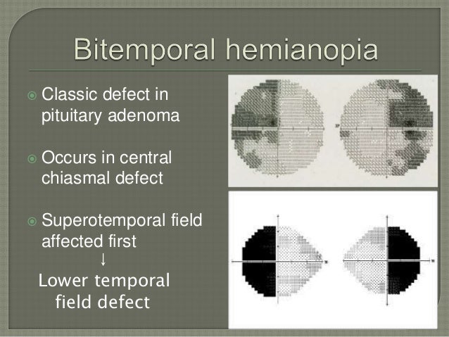 pituitary-adenoma