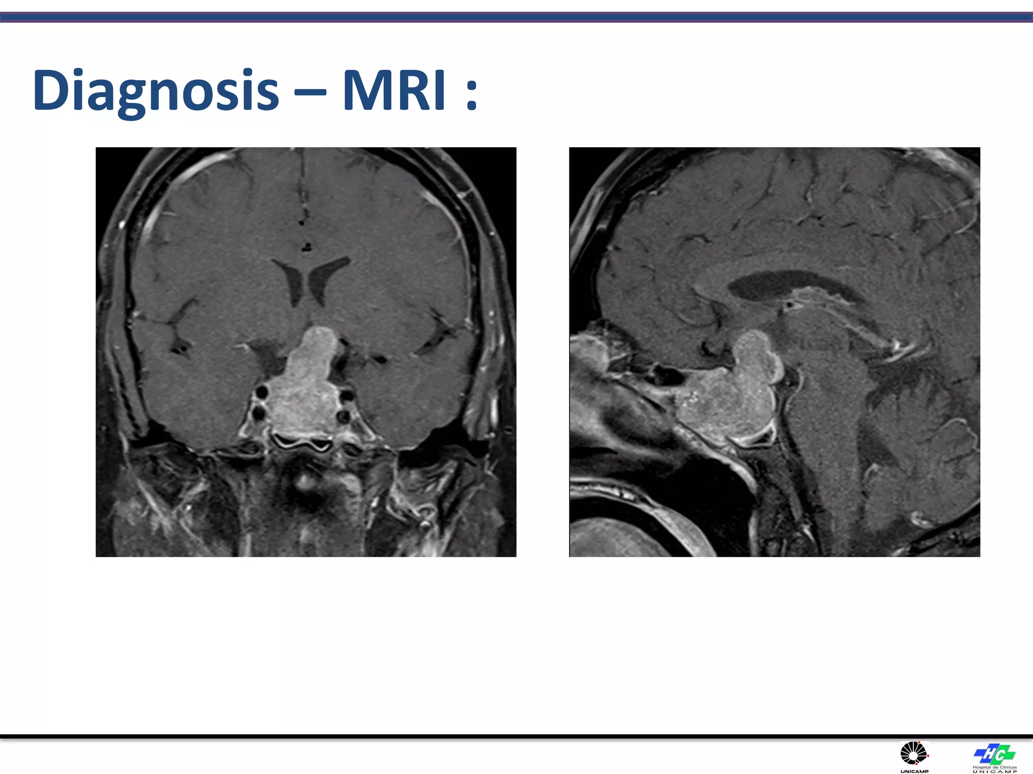 Diagnosis – MRI :
 