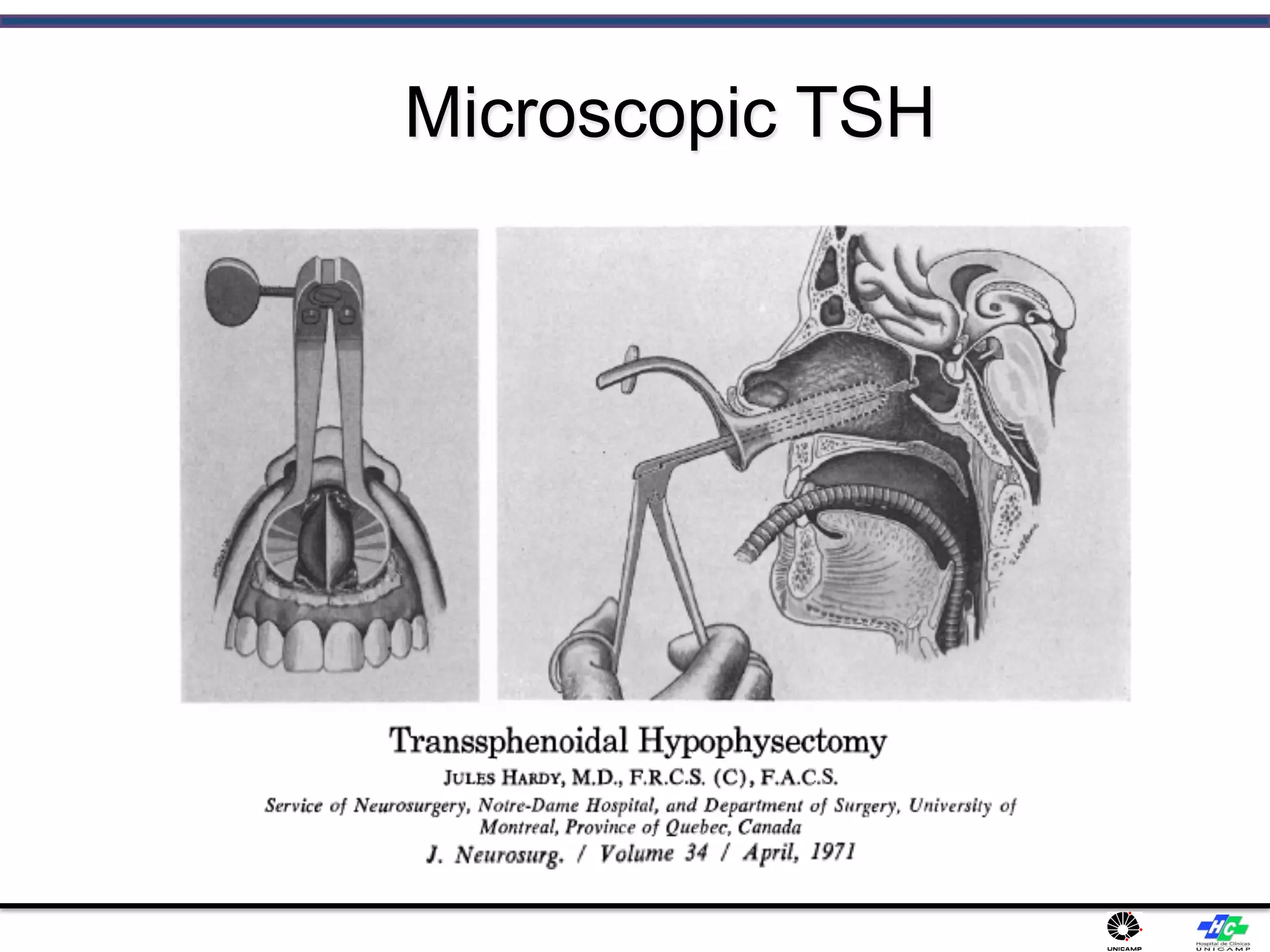Microscopic TSH
 