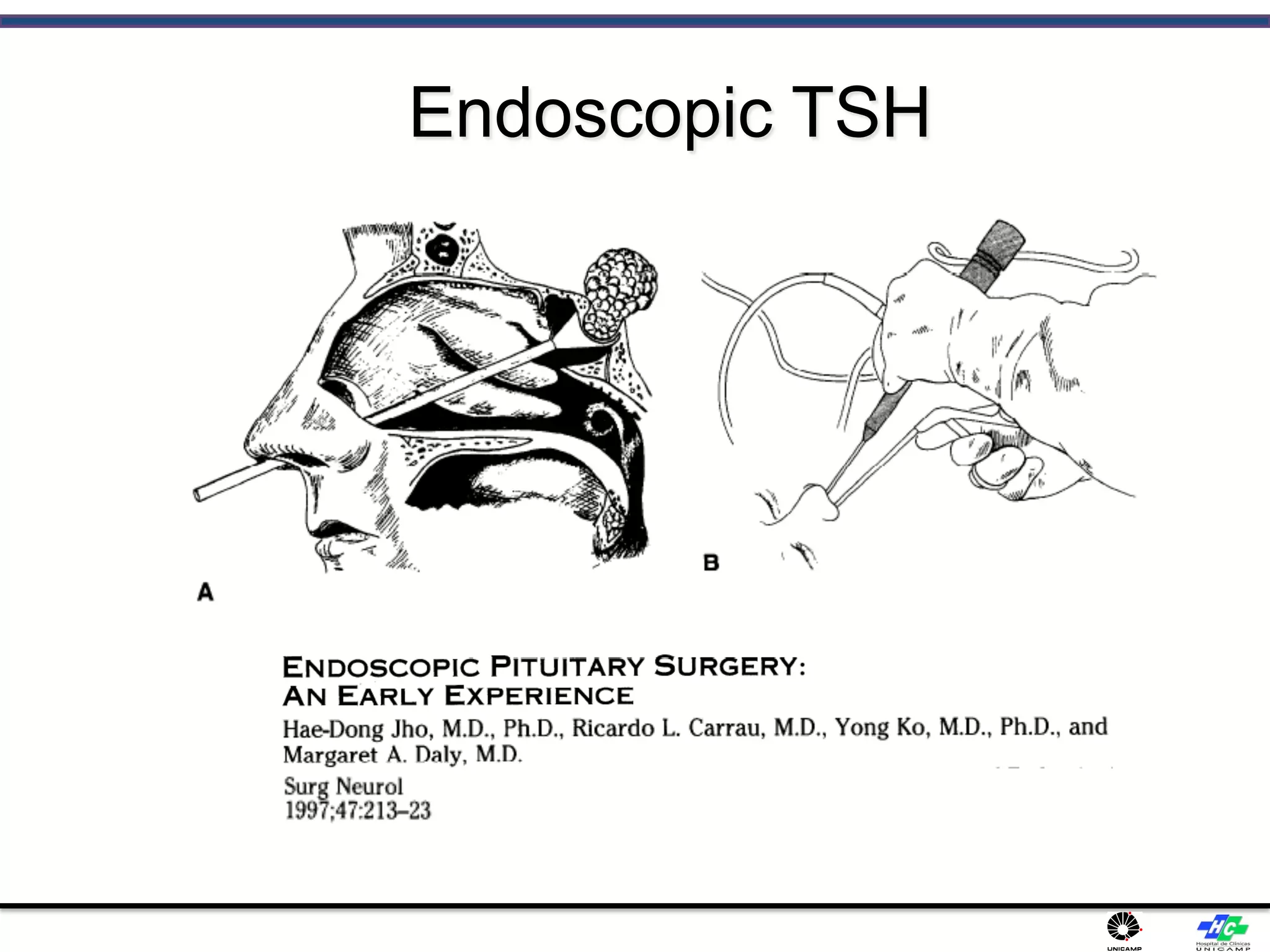 Endoscopic TSH
 