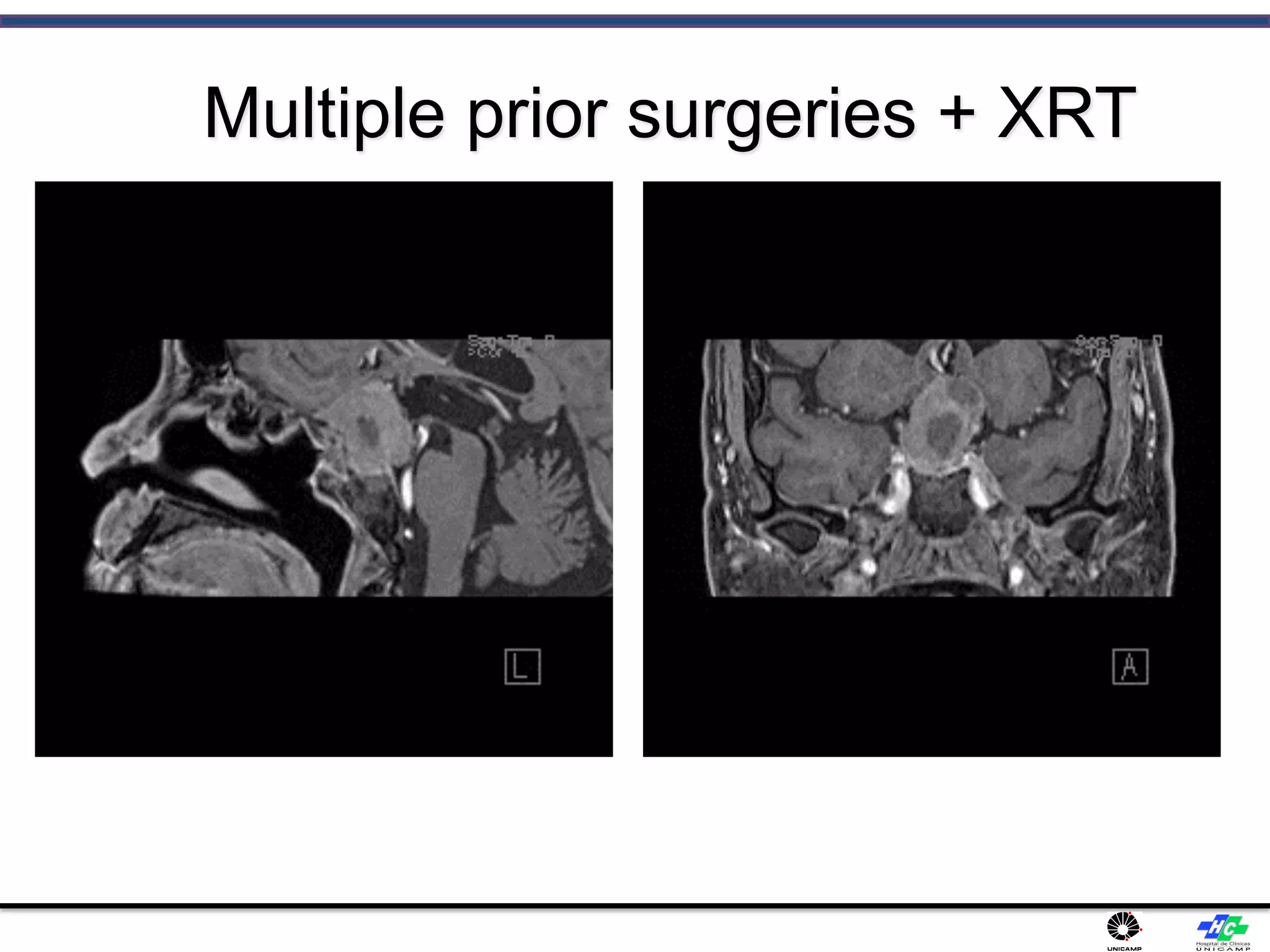 Multiple prior surgeries + XRT
 