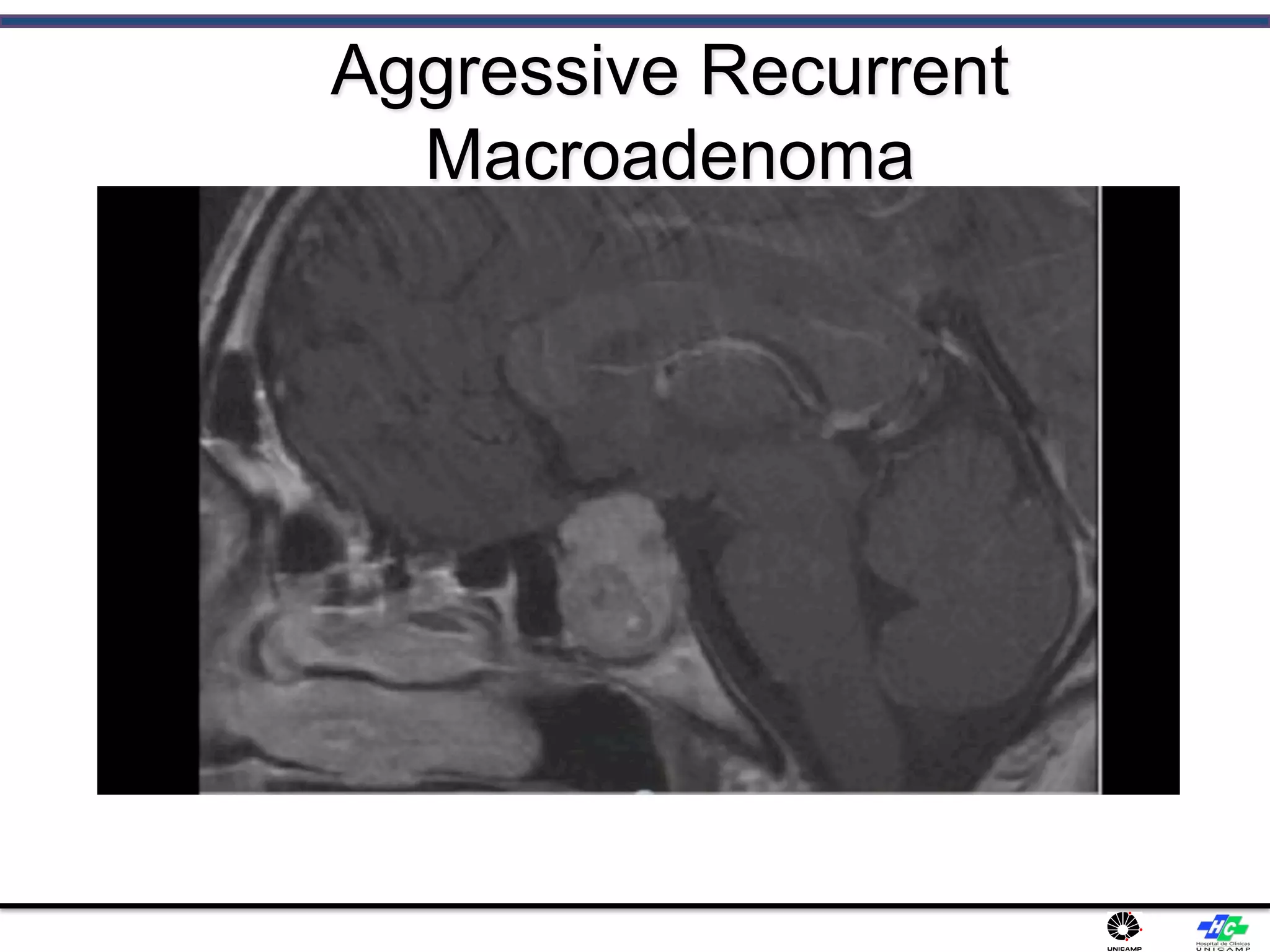 Aggressive Recurrent
Macroadenoma
 