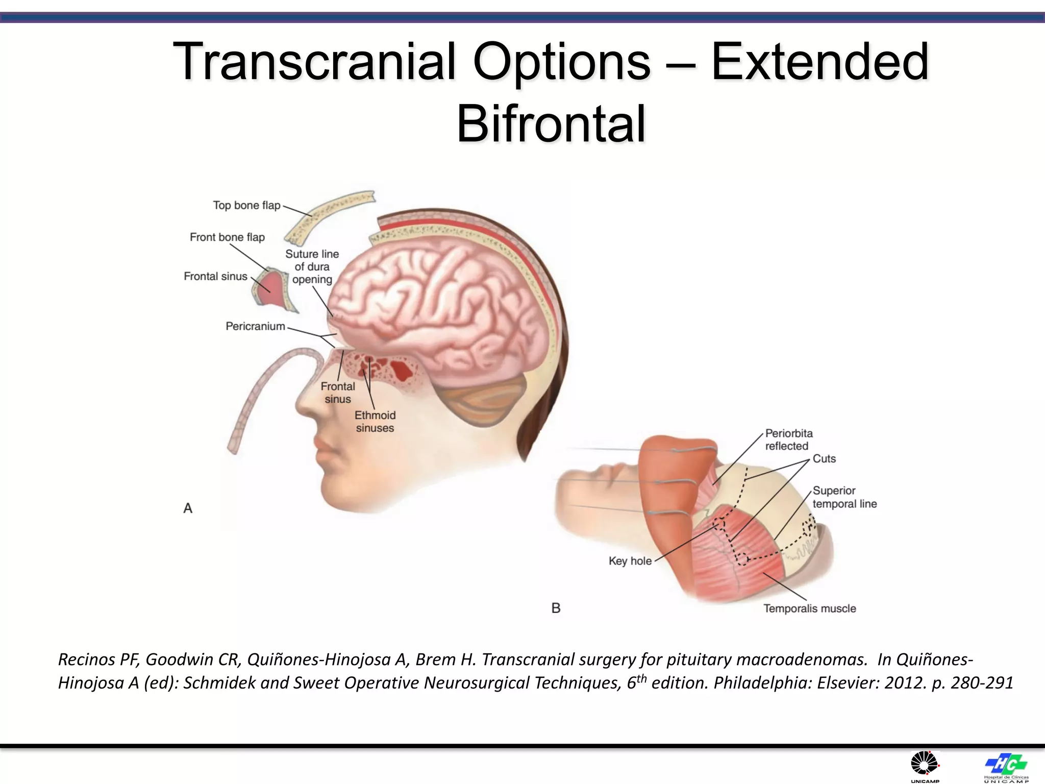 Transcranial Options – Extended
Bifrontal
Recinos PF, Goodwin CR, Quiñones-Hinojosa A, Brem H. Transcranial surgery for pituitary macroadenomas. In Quiñones-
Hinojosa A (ed): Schmidek and Sweet Operative Neurosurgical Techniques, 6th edition. Philadelphia: Elsevier: 2012. p. 280-291
 