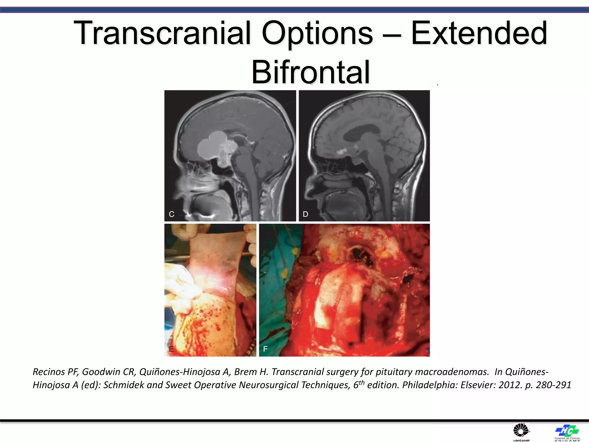 Transcranial Options – Extended
Bifrontal
Recinos PF, Goodwin CR, Quiñones-Hinojosa A, Brem H. Transcranial surgery for pituitary macroadenomas. In Quiñones-
Hinojosa A (ed): Schmidek and Sweet Operative Neurosurgical Techniques, 6th edition. Philadelphia: Elsevier: 2012. p. 280-291
 