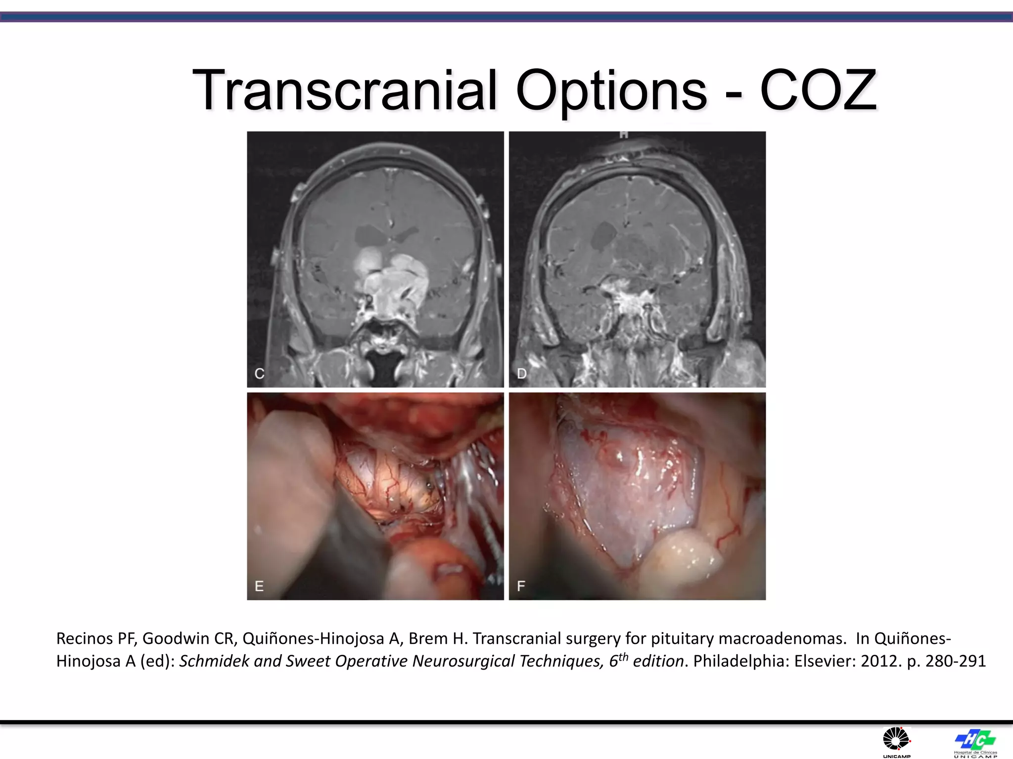 Transcranial Options - COZ
Recinos PF, Goodwin CR, Quiñones-Hinojosa A, Brem H. Transcranial surgery for pituitary macroadenomas. In Quiñones-
Hinojosa A (ed): Schmidek and Sweet Operative Neurosurgical Techniques, 6th edition. Philadelphia: Elsevier: 2012. p. 280-291
 