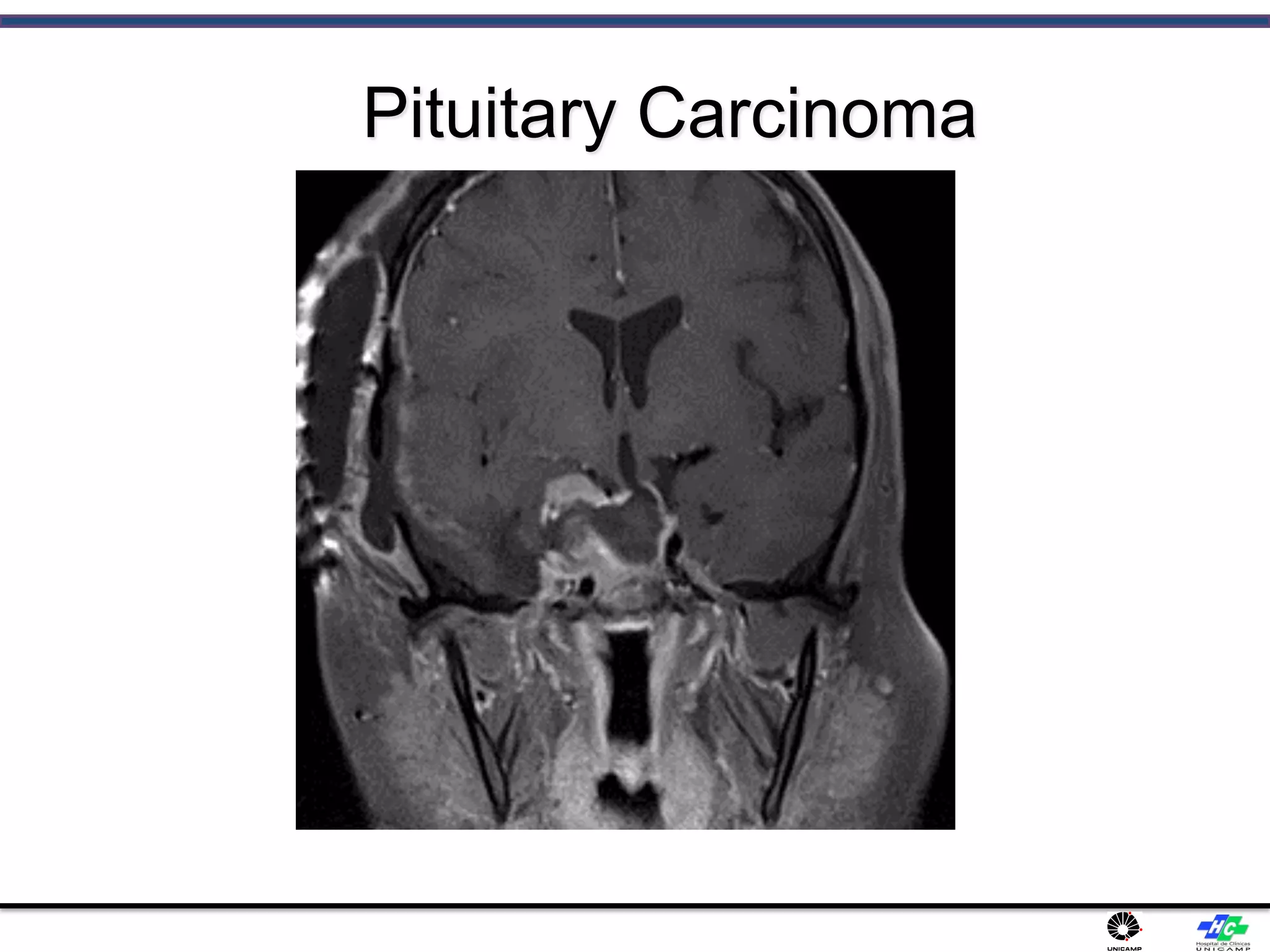 Pituitary Carcinoma
 