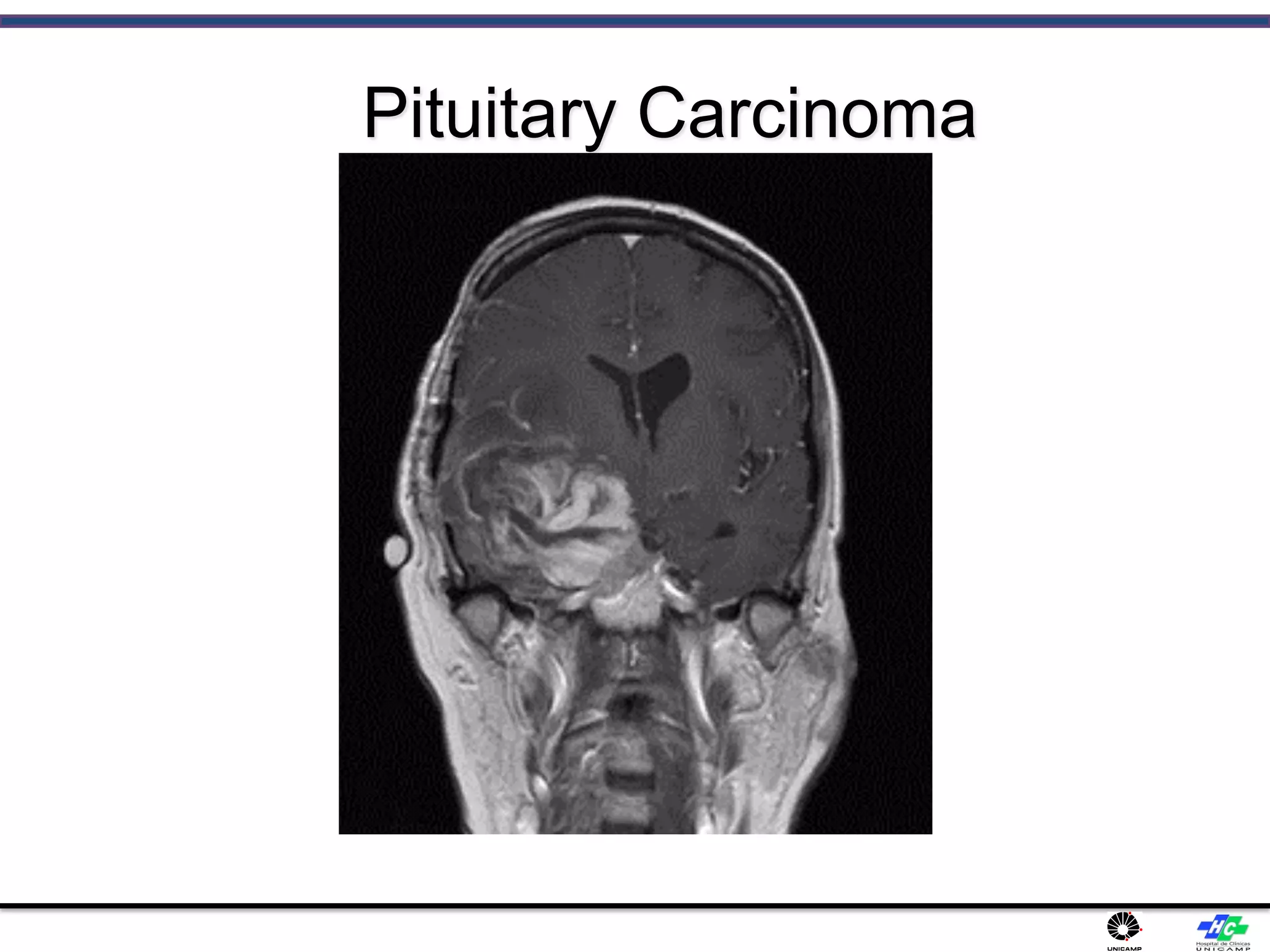 Pituitary Carcinoma
 