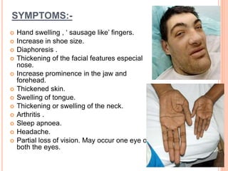 SYMPTOMS:-
 Hand swelling , ‘ sausage like’ fingers.
 Increase in shoe size.
 Diaphoresis .
 Thickening of the facial features especial
nose.
 Increase prominence in the jaw and
forehead.
 Thickened skin.
 Swelling of tongue.
 Thickening or swelling of the neck.
 Arthritis .
 Sleep apnoea.
 Headache.
 Partial loss of vision. May occur one eye or
both the eyes.
 