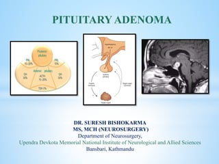 cka
DR. SURESH BISHOKARMA
MS, MCH (NEUROSURGERY)
Department of Neurosurgery,
Upendra Devkota Memorial National Institute of Neurological and Allied Sciences
Bansbari, Kathmandu
PITUITARY ADENOMA
 