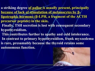 a striking degree of pallor is usually present, principally
because of lack of stimulation of melanocytes by β-
lipotrophic hormone (β-LPH, a fragment of the ACTH
precursor peptide) in the skin.
Finally, TSH secretion is lost with consequent secondary
hypothyroidism.
This contributes further to apathy and cold intolerance.
In contrast to primary hypothyroidism, frank myxoedema
is rare, presumably because the thyroid retains some
autonomous function.
 