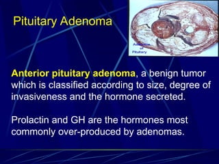 Anterior pituitary adenoma, a benign tumor
which is classified according to size, degree of
invasiveness and the hormone secreted.
Prolactin and GH are the hormones most
commonly over-produced by adenomas.
Pituitary Adenoma
 