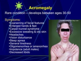 Acromegaly
Rare condition – develops between ages 30-50
Symptoms:
•Coarsening of facial features
•Enlarged hands & feet
•Carpel trunnel syndrome
•Excessive sweating & oily skin
•Headaches
•Vision disturbance
•Sleep apnea
•General tiredness
•Oligomenorrhea or amenorrhea
•Impotence (adult males)
•Decreased libido
 