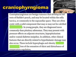 craniophyrngioma
 