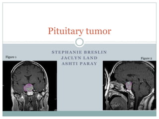 Pituitary tumor

           STEPHANIE BRESLIN
Figure 1      JACLYN LAND      Figure 2
              ASHTI PARAY
 