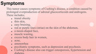 Symptoms
This tumor causes symptoms of Cushing's disease, a condition caused by
prolonged overproduction of adrenal glucocorticoids and androgens.
These includes;
■ trunal obesity
■ thin skin,
■ easy bruising,
■ red or purple lines (striae) on the skin of the abdomen,
■ a moon-shaped face,
■ muscle wasting,
■ excess body hair in women,
■ acne,
■ amenorrhea
■ psychiatric symptoms, such as depression and psychosis.
■ Cushing's disease also can trigger osteoporosis, hypertension and
 