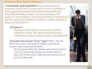 Examples of Rare Pituitary Disorders:
• Acromegaly and Gigantism: Excess growth hormone
production, usually due to a tumor; when it occurs in childhood, it
causes gigantism associated with excessive bone growth and
abnormally tall stature; in adults, it causes acromegaly, with
increases in bone thickness, coarsened facial features, enlarged hands
and feet, carpal tunnel syndrome, headaches, sweating, sleep apnea,
fatigue, and hypertension.
Treatment:
Stopping or reducing the overproduction of growth
hormone is not easy; thus, doctors may need to use a
combination of surgery, radiation therapy, and drug therapy.
Example:Vikas Kumar "Vicky" Uppal (1986 – June 30,
2007) was a native and resident of India, said to be his
country's tallest man until his death.
On 12 January 2004, The Tribune reported him to be 8 ft
3 in (2.51 m) tall and still growing, being in his late
teens. On 10 June 2005, rediff.com reported him to be 8
ft 10 in (2.69 m) tall.
 