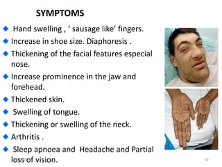 SYMPTOMS
Hand swelling , ‘ sausage like’ fingers.
Increase in shoe size. Diaphoresis .
Thickening of the facial features especial
nose.
Increase prominence in the jaw and
forehead.
Thickened skin.
Swelling of tongue.
Thickening or swelling of the neck.
Arthritis .
Sleep apnoea and Headache and Partial
loss of vision.
10/3/2023 32
 