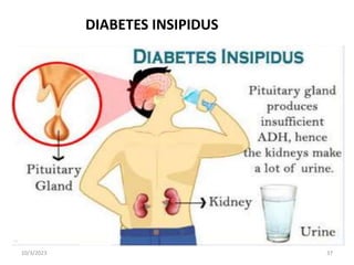 DIABETES INSIPIDUS
10/3/2023 37
 