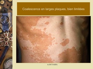 Coalescence en larges plaques, bien limitées 