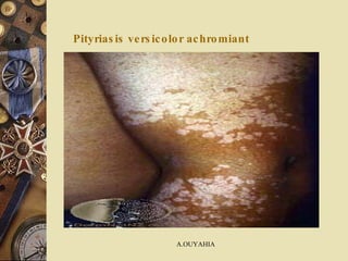 Pityriasis versicolor achromiant 