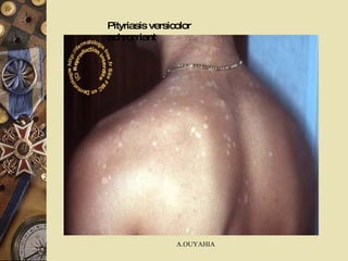 Pityriasis versicolor achromiant 