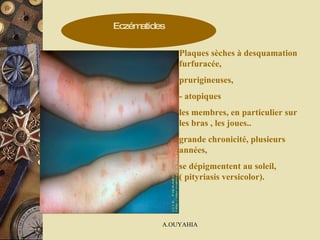 Eczématides Plaques sèches à desquamation furfuracée, prurigineuses, - atopiques les membres, en particulier sur les bras , les joues..  grande chronicité, plusieurs années,  se dépigmentent au soleil, ( pityriasis versicolor). 