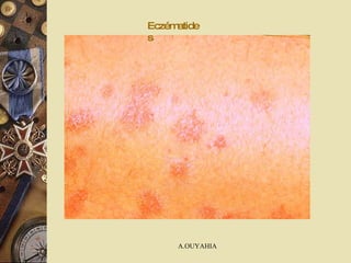 Eczématides 