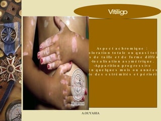 Aspect achromique :  décoloration totale ou quasi totale. Taches de taille et de forme différente,  localisation asymétrique. Apparition progressive en quelques mois ou années. - Atteinte des extrémités et périorificielle. Vitiligo 