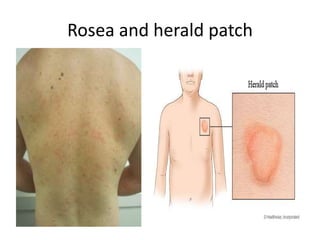 Ovoid Rash Pityriasis rosea | PPTX