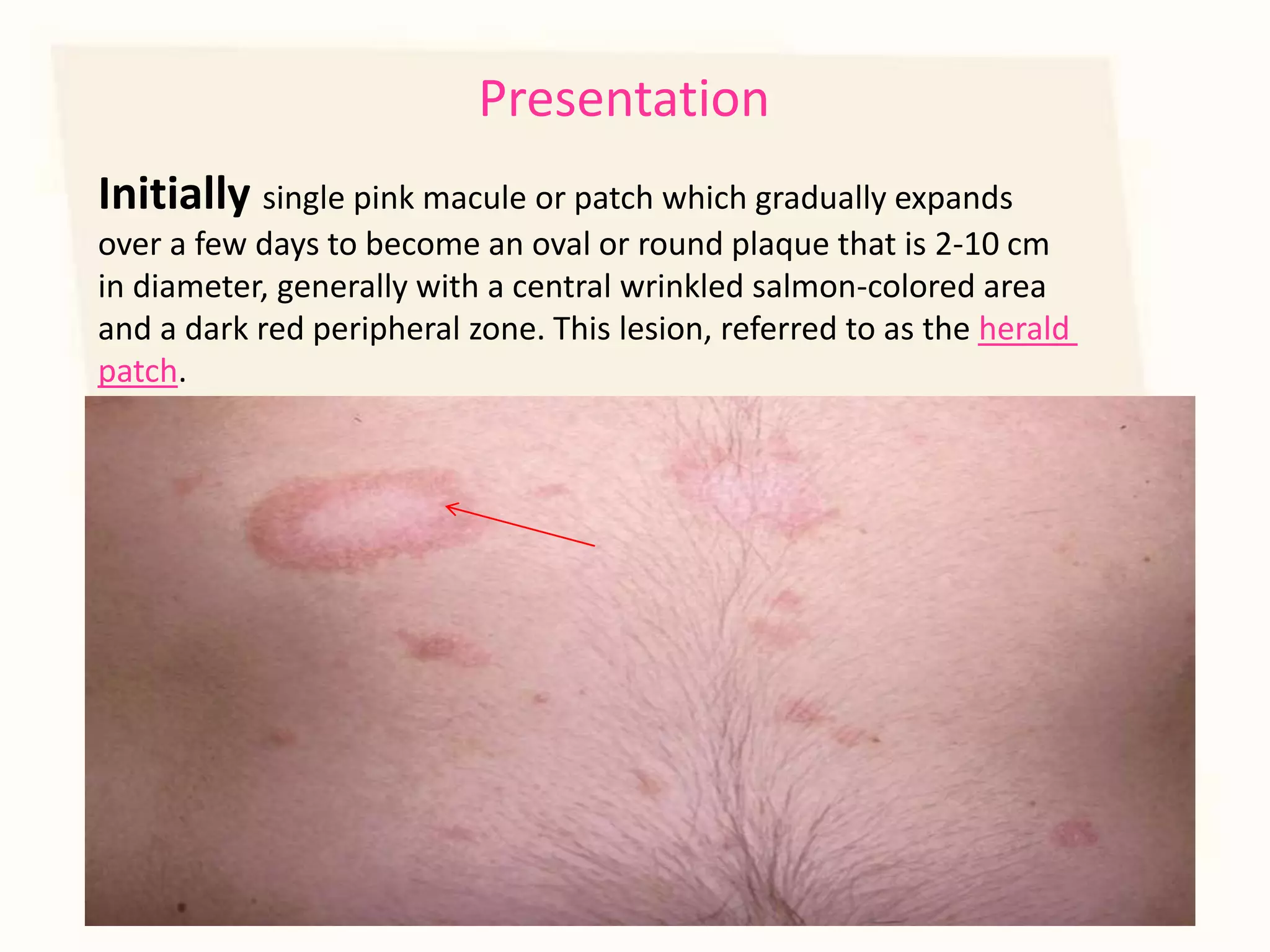 Pityriasis rosea | PPTX